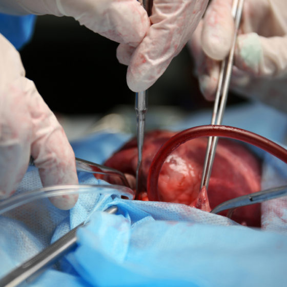 The First in Ukraine Child Heart Transplantation